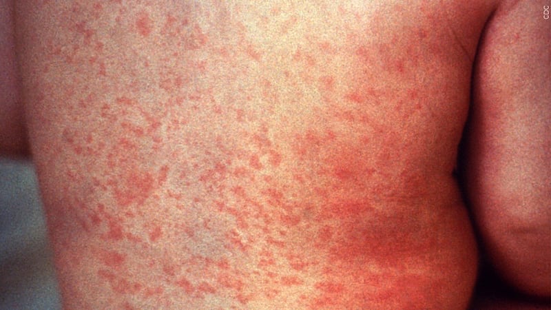 Pinal County reported its first measles case of the season.