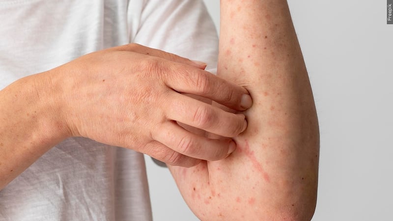 PHOTO: Skin rash seen after a measles contamination. Freepik