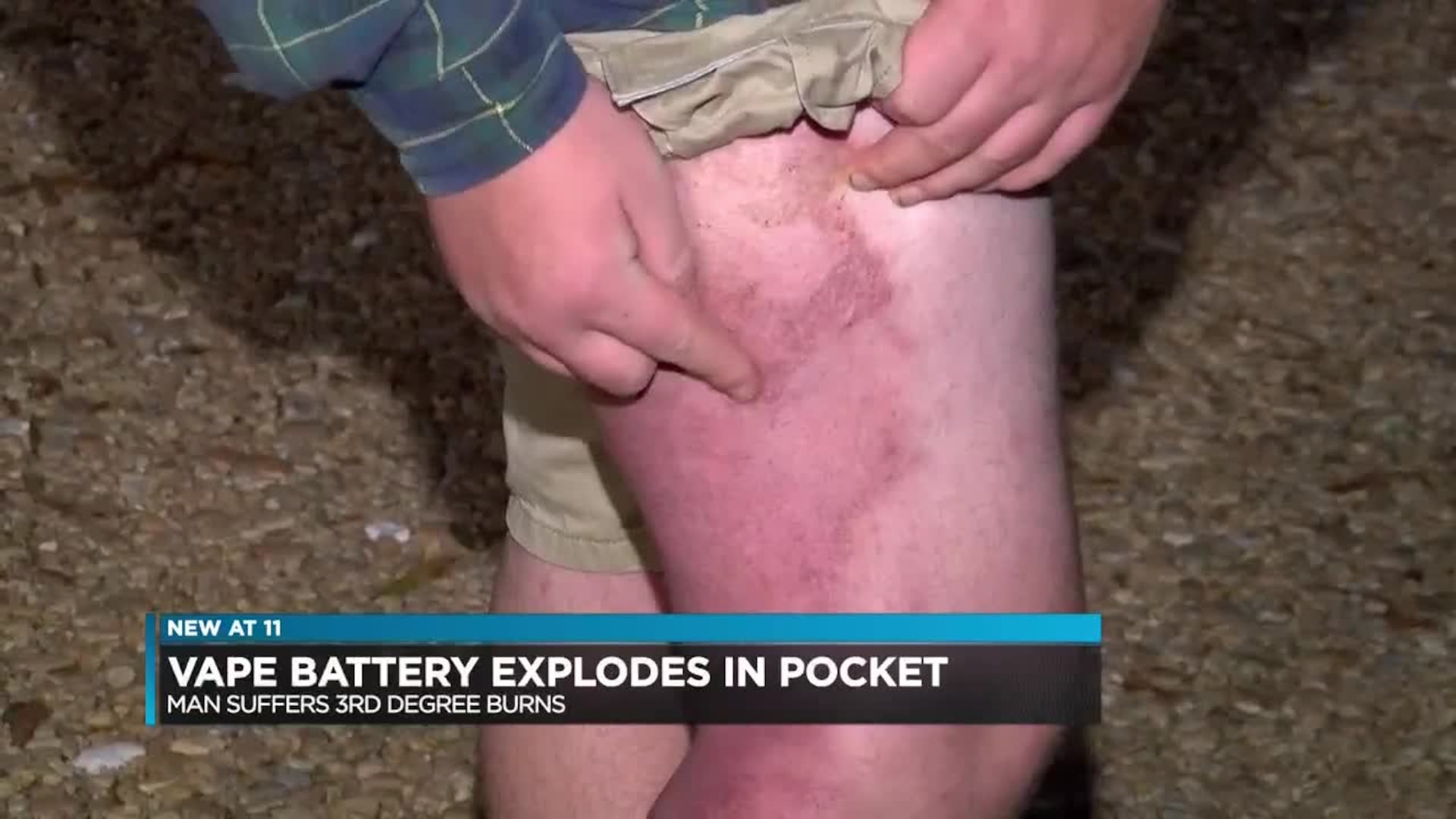 Vape battery explodes in man's pocket Vape battery explodes in man's pocket